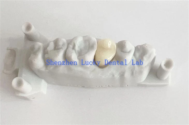Aesthetic Dental Full Contour Zirconia Crown