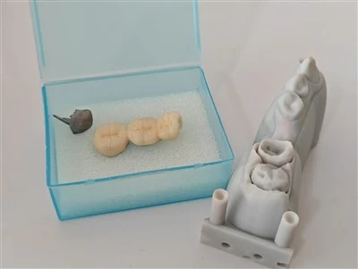 Персонализирана 3D печат циркония корона и дентална лаборатория